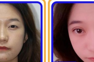 成都中醫(yī)大銀海眼科醫(yī)院路雪婧整形價(jià)格表附眼部整形案例展示