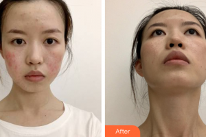 廣州康華清醫(yī)學美容門診部王群整形價格表附點陣激光祛痘案例展示