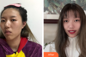 廣州從化現(xiàn)代醫(yī)院歐陽志珊整形價格表附白瓷娃娃案例展示