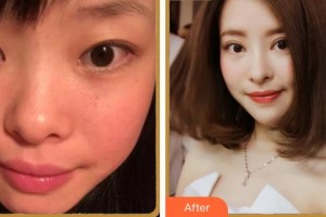 成都中醫(yī)大銀海眼科醫(yī)院黃霄整形價(jià)格表附眼部整形案例展示