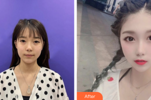 廣州康華清醫(yī)學美容門診部萬佩整形價格表附光子嫩膚案例展示