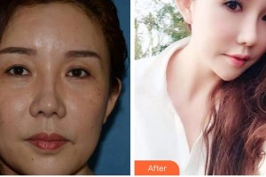 成都中醫(yī)大銀海眼科醫(yī)院張大錚整形價(jià)格表附眼部綜合案例展示