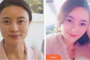 成都中醫(yī)大銀海眼科醫(yī)院王國(guó)平整形價(jià)格表附眼部整形案例展示