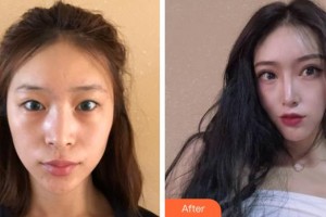 成都中醫(yī)大銀海眼科醫(yī)院袁曉輝整形價(jià)格表附雙眼皮案例展示