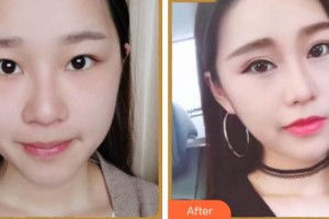 成都中醫(yī)大銀海眼科醫(yī)院霍劍整形價(jià)格表附眼部多項(xiàng)案例展示