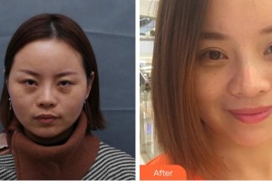 成都中醫(yī)大銀海眼科醫(yī)院文娟住院醫(yī)師整形價(jià)格表附眼部綜合案例展示