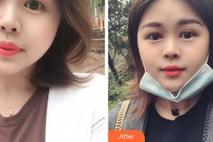 成都中醫(yī)大銀海眼科醫(yī)院陳浩整形價(jià)格表附雙眼皮案例展示