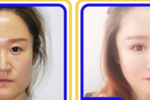 成都中醫(yī)大銀海眼科醫(yī)院陳小鳳整形價(jià)格表附眼部綜合案例展示