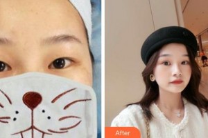 成都中醫(yī)大銀海眼科醫(yī)院蒙軒住院醫(yī)師整形價(jià)格表附眼部手術(shù)案例展示