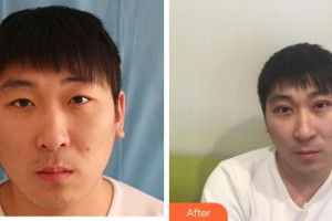 成都中醫(yī)大銀海眼科醫(yī)院王利萍住院醫(yī)師整形價(jià)格表附切開雙眼皮案例展示