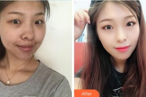 成都新視界眼科醫(yī)院賈春月整形價(jià)格表附眼部手術(shù)案例展示