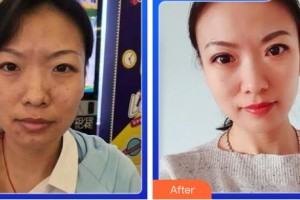 成都新視界眼科醫(yī)院余小清整形價(jià)格表附5s重瞼術(shù)+超微創(chuàng)開內(nèi)眥案例展示