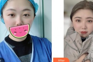 成都新視界眼科醫(yī)院賈立整形價(jià)格表附眼部整形案例展示