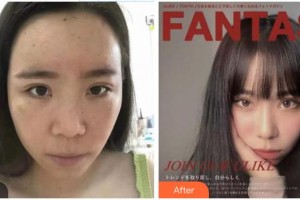 成都新視界眼科醫(yī)院屈雪梅整形價(jià)格表附切開重瞼+內(nèi)眥贅皮矯正案例展示