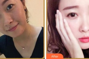 成都新視界眼科醫(yī)院趙江華整形價(jià)格表附眼部多項(xiàng)案例展示