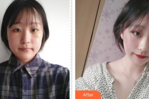 成都新視界眼科醫(yī)院唐建整形價(jià)格表附眼部整形案例展示