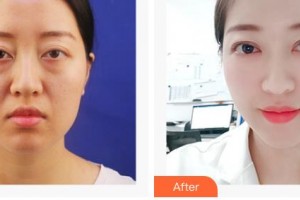 成都新視界眼科醫(yī)院李靜整形價格表附眼部綜合案例展示