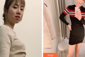 福建武警總隊醫(yī)院激光美容中心林美回整形價格表附光子套餐案例展示