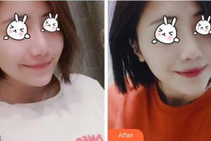 福建武警總隊醫(yī)院激光美容中心牛克輝整形價格表附無針水光案例展示