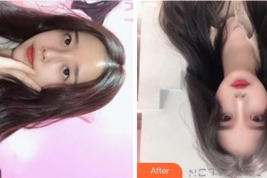 福建武警總隊醫(yī)院激光美容中心張召整形價格表附微針美膚案例展示