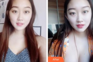 福建省立醫(yī)院整形外科劉加寧整形價格表附豐胸案例展示