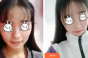 福建武警總隊醫(yī)院激光美容中心李碧容整形價格表附無針水光案例展示