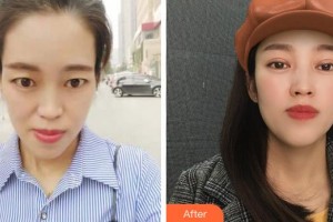 福建醫(yī)科大學附屬第二醫(yī)院眼科中心陳淑端整形價格表附切開雙眼皮案例展示