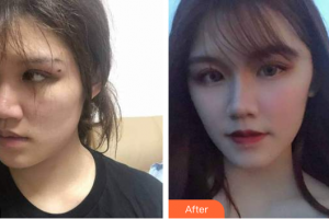 廣州中科美整形醫(yī)院鄧詠整形價格表附人魚膠提升術(shù)案例展示