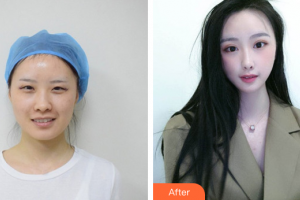 廣州天姿醫(yī)學美容門診部侯文明整形價格表附眼部整形案例展示