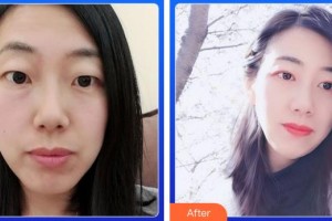 福建武警總隊醫(yī)院激光美容中心都志杰整形價格表附5s雙眼皮案例展示