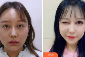 福建省立醫(yī)院整形外科鄭勝武整形價格表附雙眼皮+眼瞼下至案例展示