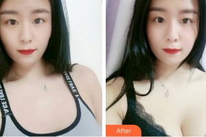 福建武警總隊醫(yī)院激光美容中心吳云飛整形價格表附濃縮豐胸真實案例展示