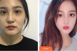 福建省立醫(yī)院整形外科鄭清健整形價格表附鼻部手術(shù)案例案例展示