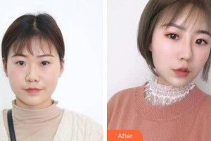 福建醫(yī)科大學附屬協(xié)和醫(yī)院整形激光美容中心江成鴻整形價格表附膨體隆鼻案例展示