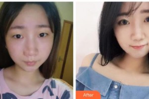 福建醫(yī)科大學附屬第一醫(yī)院整形美容外科王美水整形價格表附眼部整形案例展示