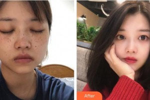 福建醫(yī)科大學附屬協(xié)和醫(yī)院整形激光美容中心周亞寬整形價格表附激光美膚案例展示