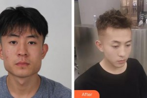 福建醫(yī)科大學附屬第一醫(yī)院整形美容外科鄭厚兵整形價格表附DA·頜面整形案例展示