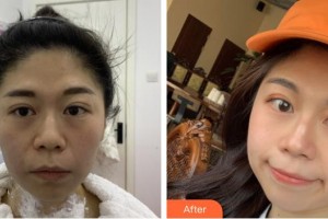 福建武警總隊醫(yī)院激光美容中心鄭清建整形價格表附熱瑪吉抗衰案例展示