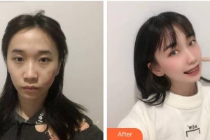 福建醫(yī)科大學附屬協(xié)和醫(yī)院整形激光美容中心楊育成整形價格表附縫針疤痕案例展示