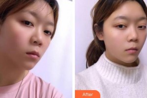 福建醫(yī)科大學附屬第二醫(yī)院眼科中心吳瑜瑜整形價格表附眼部案例展示