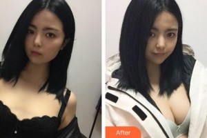 福建省人民醫(yī)院整形中心陳友義整形價格表附濃縮豐胸真實案例展示