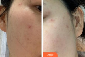 福建武警總隊醫(yī)院激光美容中心文維整形價格表附雙激光美膚案例展示