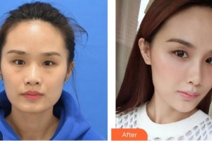 福建醫(yī)科大學附屬第二醫(yī)院眼科中心洪玉整形價格表附祛眼袋案例展示