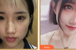 福建醫(yī)科大學(xué)附屬第一醫(yī)院整形美容外科王彪整形價(jià)格表附自體脂肪填充案例展示