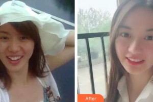 福州華仁醫(yī)療整形美容醫(yī)院林儉整形價(jià)格表附牙綜合案例展示