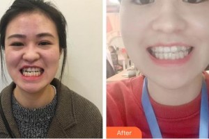 福州美貝爾醫(yī)療美容門診部石曾領(lǐng)整形價格表附隱形牙齒矯正案例展示