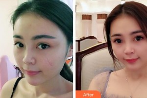 福州美萊華美美容醫(yī)院徐爽整形價格表附疤痕案例展示