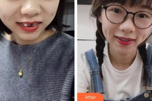 福州美萊華美美容醫(yī)院陳涵整形價格表附缺牙妹妹變形記案例展示