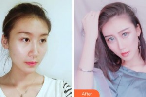 福州隆美爾整形美容醫(yī)院謝義德整形價格表附隆鼻案例展示