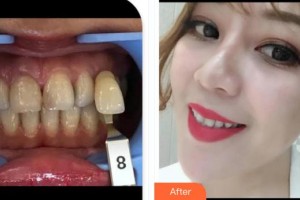 福州美萊華美美容醫(yī)院黃思遠整形價格表附牙齒美白案例展示